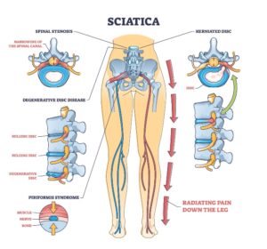 causes of sciatica